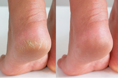 Need to Know About Cracked Feet