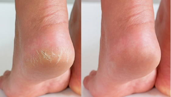 Need to Know About Cracked Feet