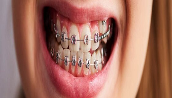 Orthodontic Procedures and Treatment