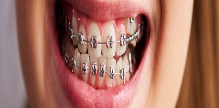 Orthodontic Procedures and Treatment
