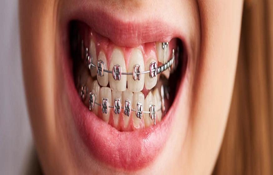 Orthodontic Procedures and Treatment