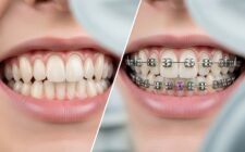 Clear aligners