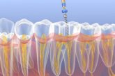 emergency endodontic treatment