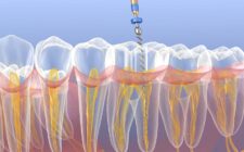 emergency endodontic treatment