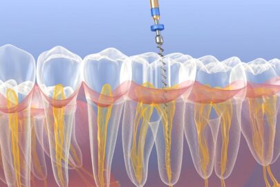 emergency endodontic treatment
