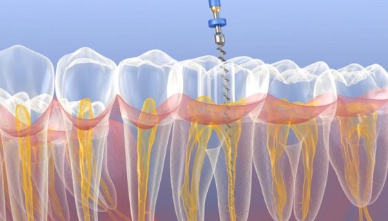 emergency endodontic treatment