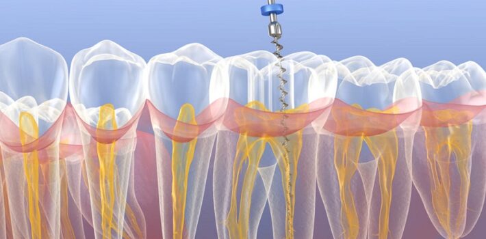 emergency endodontic treatment