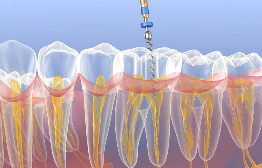emergency endodontic treatment