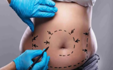 tummy tuck procedures