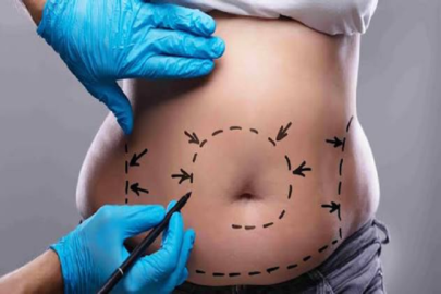 tummy tuck procedures