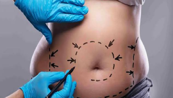 tummy tuck procedures