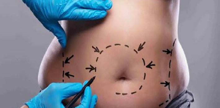 tummy tuck procedures